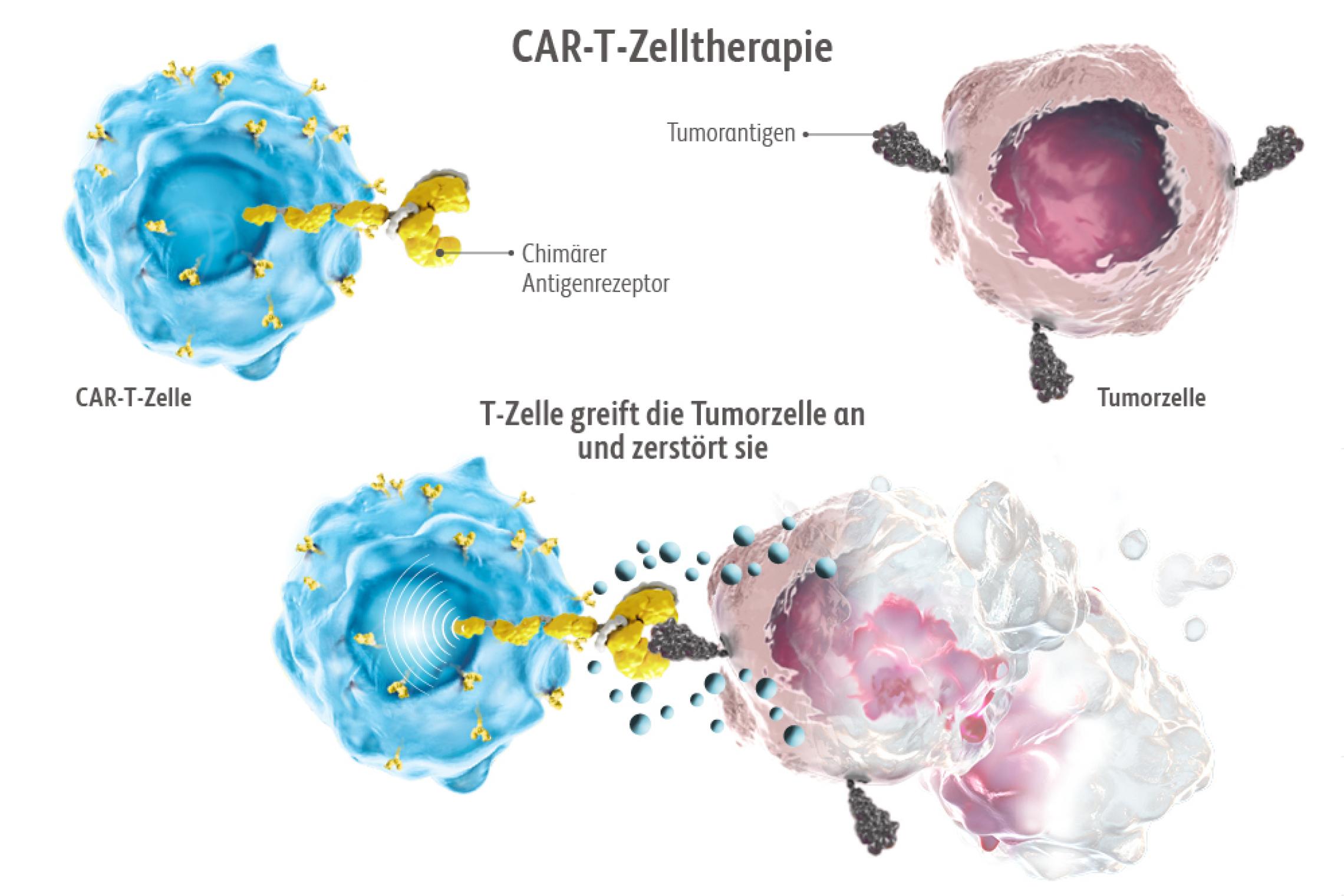 CAR-T-Zelltherapie | BMS-Pflege-Onkologie